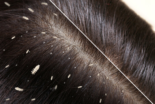 Lice Treatment